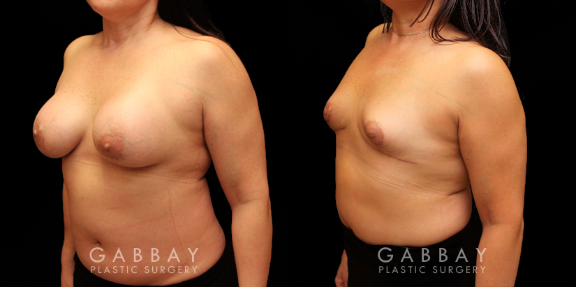 Procedures Depicted:  Auto Augmentation with lift