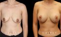 Scar revision to breasts results with additional breast augmentation and lift combination. Patient improved breast size and position with mild scarring only.