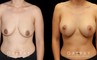 Scar revision to breasts results with additional breast augmentation and lift combination. Patient improved breast size and position with mild scarring only.
