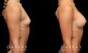 Patient before and after breast augmentation with silicone implants for both breasts. Patient’s naturally slender body type balanced well with smaller implants.