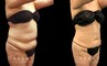 Mid 40s female patient after abdominal liposuction results have full healed, showing a tightened lower torso with belly rolls smoothed out for a flatter overall contour.