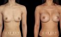 Before-and-after photos for breast augmentation showing fully recovered patient. Note the lack of visible scarring despite the dramatic increase to bust volume. Balanced, round breast shape enhances the patient’s natural figure.