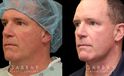 Male neck liposuction results for mid 50s man. Photos demonstrate the contour around the jawline for an overall enhanced masculine jawline contour. Though subtle and refined, the results are noticeable from multiple angles.