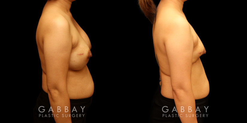 Procedures Depicted:  Breast implant removal and lift
