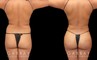 Full 360 view of patient following liposuction surgery focusing on removing belly fat, fat around the waist, and tailbone fat for a contoured result from every angle.