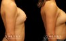 Patient before-and-after photos for implant removal and replacement procedure. This revision breast augmentation went well and patient was satisfied with how her new implants looked and felt.