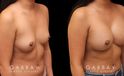 Photos of breast augmentation patient results, including before procedure and after once the patient fully recovered. Increased breast roundness allowed for the patient to see an unique aesthetic.