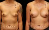 Silicone implants were used to increase breast roundness and volume. Note how the breasts kept their position while filling out for a balanced appearance.
