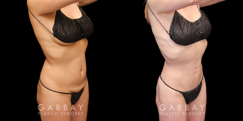 Patient 06 Front View Mini Tummy Tuck Gabbay Plastic Surgery