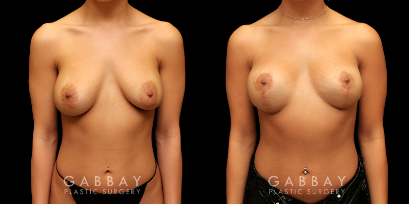 Procedures Depicted:  Removal and Replacement of SIL Implants; capsulorrhaphy