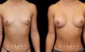 Patient before and after breast augmentation with silicone implants for both breasts. Patient’s naturally slender body type balanced well with smaller implants.