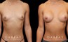 Patient before and after breast augmentation with silicone implants for both breasts. Patient’s naturally slender body type balanced well with smaller implants.