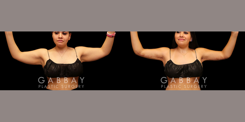 Patient 02 Back View Arm Lift Gabbay Plastic Surgery