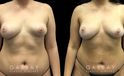 Patient 07 Front View Breast Fat Grafting Gabbay Plastic Surgery