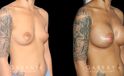 Before-and-after photos for breast augmentation with saline implants. The choice of saline implants allowed for more dramatic increase in breast size while having no visible scars.