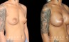 Before-and-after photos for breast augmentation with saline implants. The choice of saline implants allowed for more dramatic increase in breast size while having no visible scars.