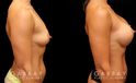 Patient photos showing before and after her breast augmentation procedure, with notable breast size increase while maintaining a balanced aesthetic.