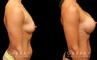 Patient photos showing before and after her breast augmentation procedure, with notable breast size increase while maintaining a balanced aesthetic.