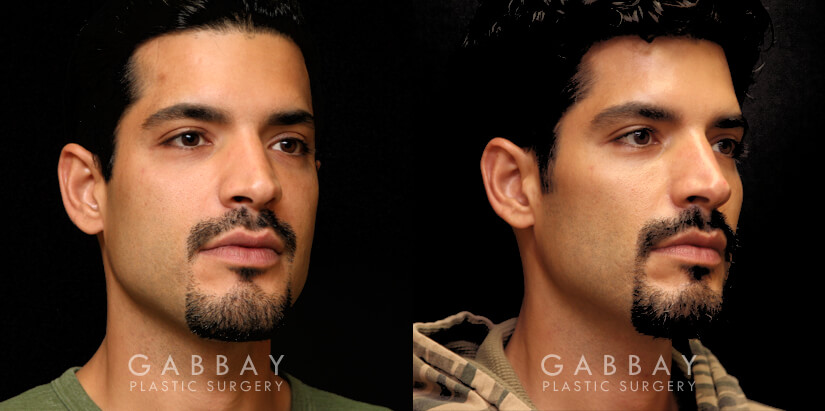 Procedures Depicted:  Buccal Fat Pad Removal