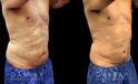 Male liposuction before-and-after photo for 360 lipo showing a result in a slimmer waist and flatter abdominal area for an enhanced torso contour. Flanks are significantly slimmed and present a toned silhouette.