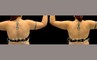Patient 15 Back View Lipo Arms Gabbay Plastic Surgery