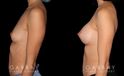 Patient result photos following silicone implant breast augmentation. Patient elected for a rounder shape with mild breast protrusion for subtle yet alluring results.