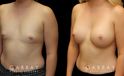 Patient results for breast augmentation with silicone implants. Before there was minimal breast volume, with the results increasing size without damaging the skin around the breasts. Note the lack of visible scarring.