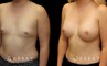 Patient results for breast augmentation with silicone implants. Before there was minimal breast volume, with the results increasing size without damaging the skin around the breasts. Note the lack of visible scarring.