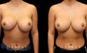 Patient 02 Front View Breast Revision Gabbay Plastic Surgery