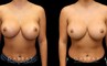 Patient 02 Front View Breast Revision Gabbay Plastic Surgery