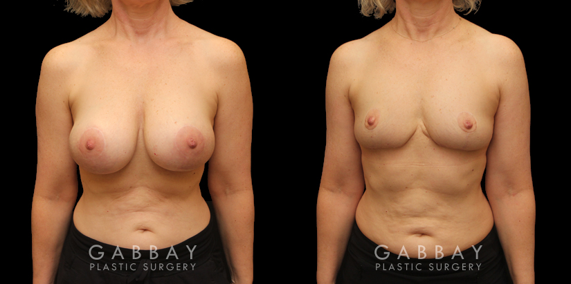 Procedures Depicted:  Auto Augmentation with mesh