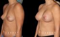 Silicone implants used to increase breast size in female patient in her 30s. Boost ot breast volume resulted in a more feminine contour from each before-and-after photo angle.