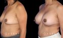 Patient before and after silicone implants with complete, uncomplicated recovery. Volume increase is notable while also improving the balance between breasts without resorting to unnatural perfect symmetry.