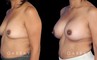 Patient before and after silicone implants with complete, uncomplicated recovery. Volume increase is notable while also improving the balance between breasts without resorting to unnatural perfect symmetry.
