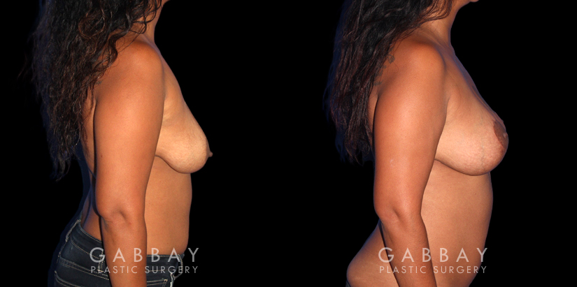 Procedures Depicted:  Wise Mastopexy with Silicone Breast Implants