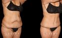 Note the significant tightening of the loose pockets of skin and stubborn fat around the abdomen following weight loss. After her tummy tuck, this patient saw a flattened stomach and enjoyed the benefits of her effort to lose weight.