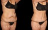 Note the significant tightening of the loose pockets of skin and stubborn fat around the abdomen following weight loss. After her tummy tuck, this patient saw a flattened stomach and enjoyed the benefits of her effort to lose weight.
