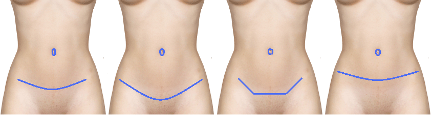 Endoscopic Abdominoplasty