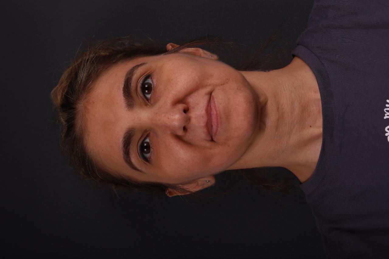 Deep Plane Facelift - Before