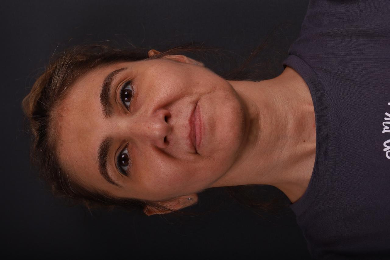 Deep Plane Facelift - After