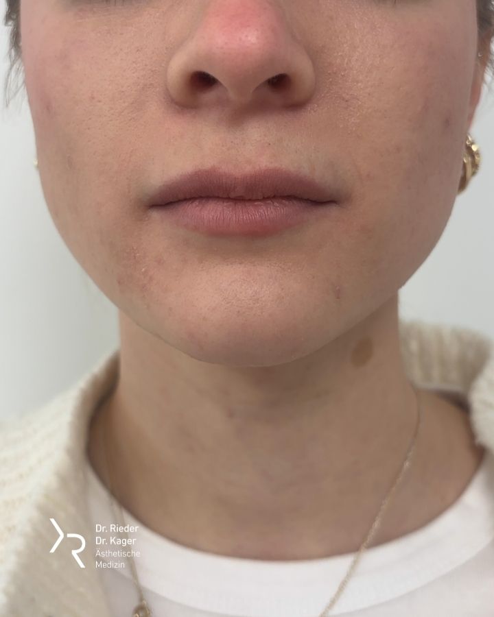 Lippenkorrektur - Vorher/Nachher Vergleich - Nachher