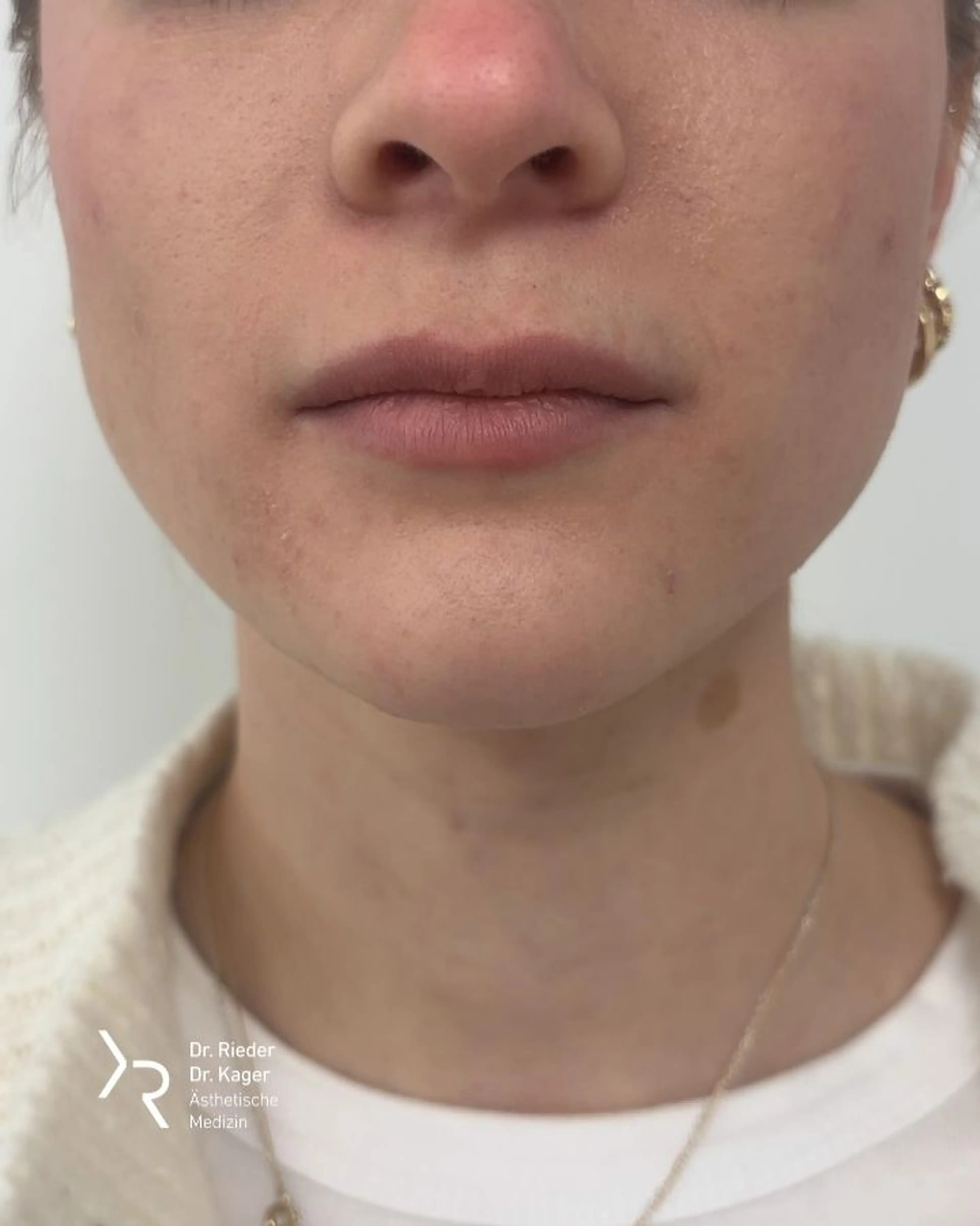Lippenkorrektur - Vorher/Nachher Vergleich - Nachher