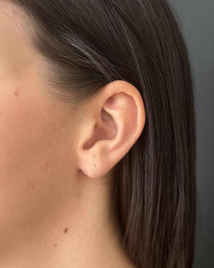 Eingerissene Ohrläppchen - Vorher/Nachher Vergleich - Nachher