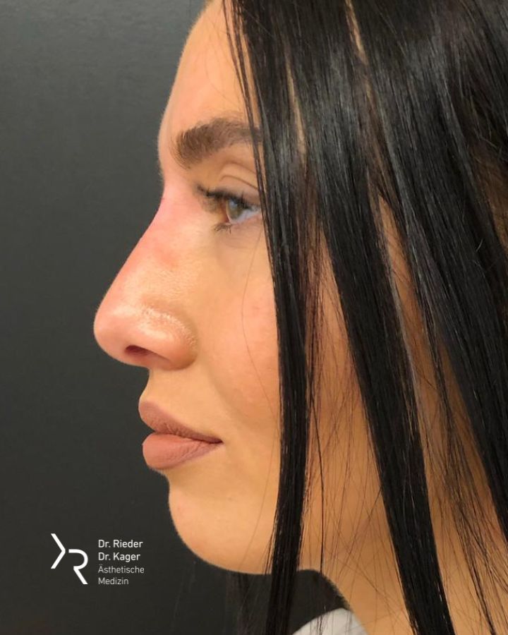 Nasenkorrektur mit Hyaluronsäure - Vorher/Nachher Vergleich - Nachher