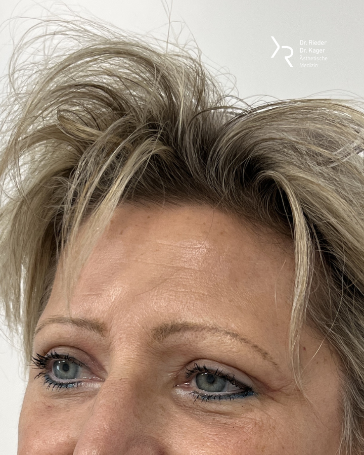 Oberlidstraffung - Vorher/Nachher Vergleich - Nachher