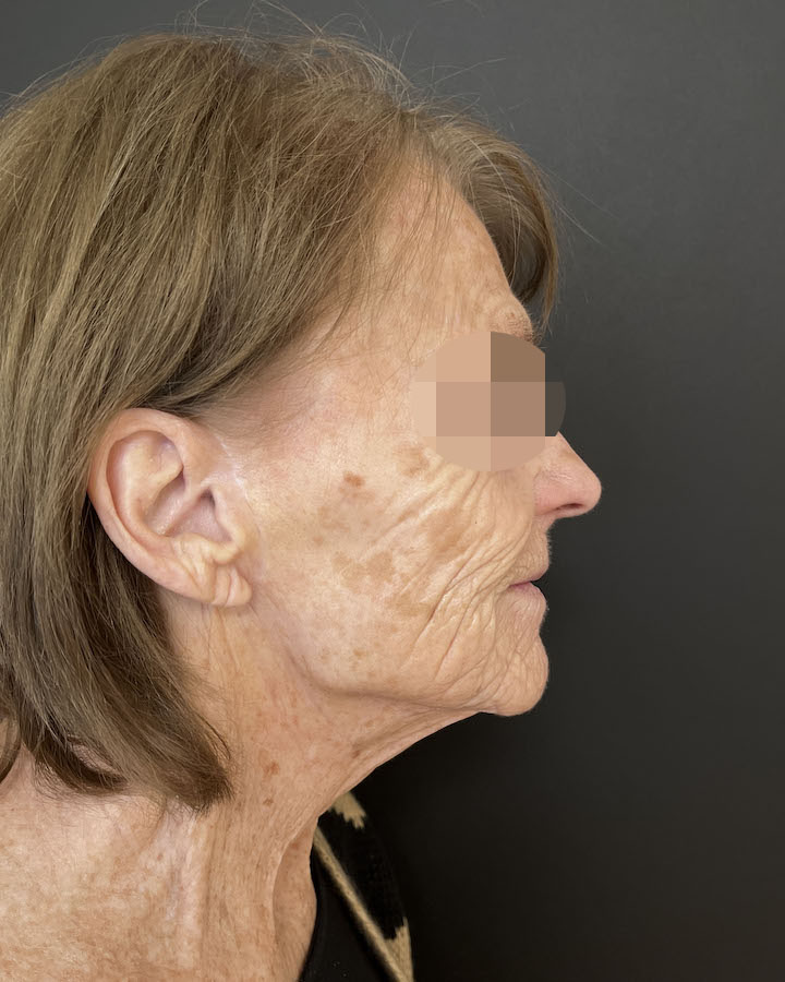 Phenol-Menal - Vorher/Nachher Vergleich - Vorher