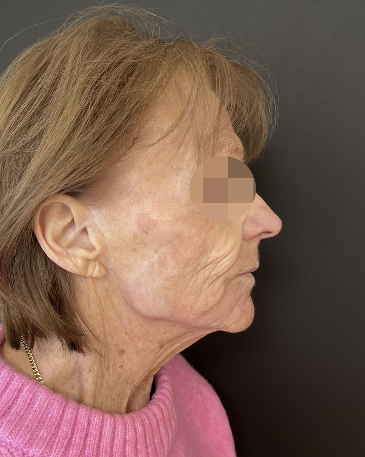 Phenol-Menal - Vorher/Nachher Vergleich - Nachher