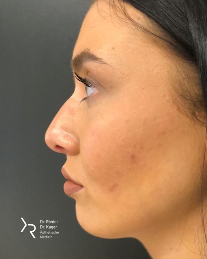 Nasenkorrektur mit Hyaluronsäure - Vorher/Nachher Vergleich - Vorher