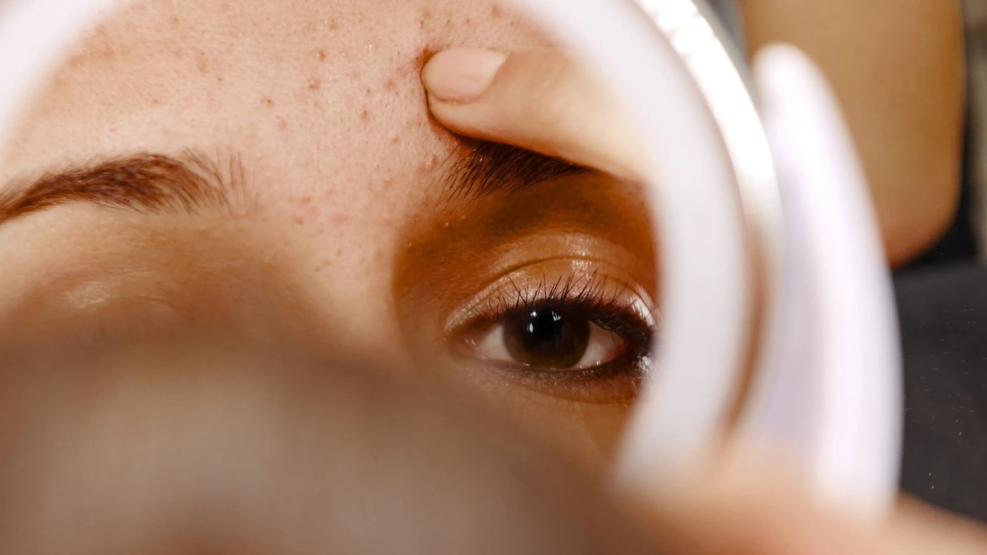 Aknefacial.jpg