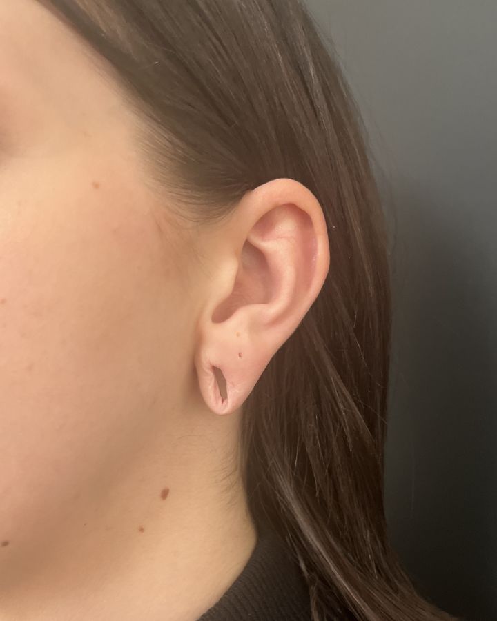 Eingerissene Ohrläppchen - Vorher/Nachher Vergleich - Vorher